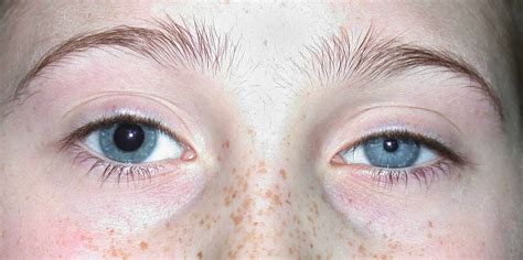Anisocoria Causes Anisocoria In Babies Causes Diagnosis And Treatment