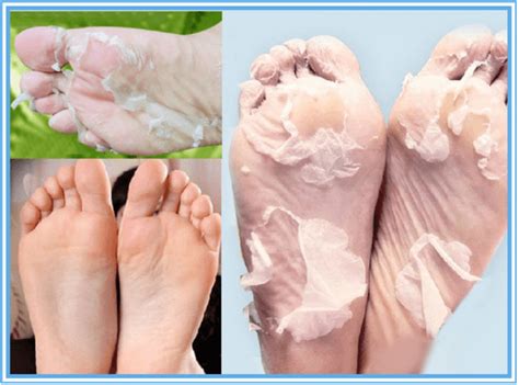 Top 10 Natural Remedies To Remove Calluses From Feet