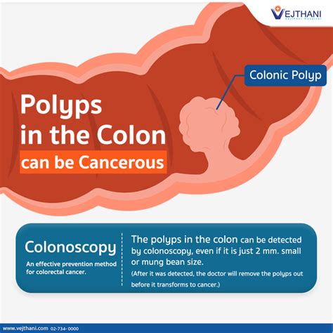 Polyps In The Colon Can Be Cancerous Vejthani Hospital Jci