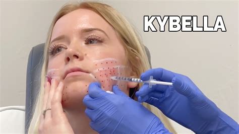 Kybella For Facial Slimming And Jawline Contour Youtube