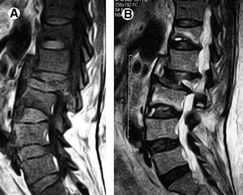 Osteoporotic Compression Fracture Of T12 L2 And L3 Vertebrae In A