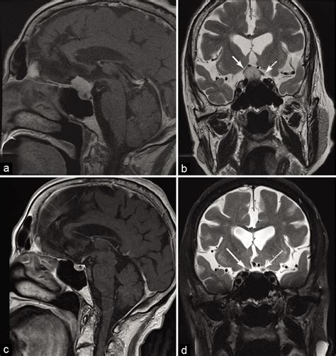 Single Surgeon Experience With Minimally Invasive Supraorbital