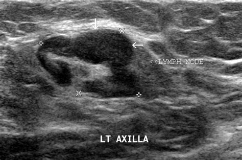 Ultrasound Imaging Breast Cancer With Spread To Lymph Nodes