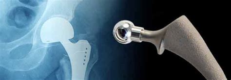 Stryker Lfit Cocr V40 Femoral Head Recall Doliveira And Associates