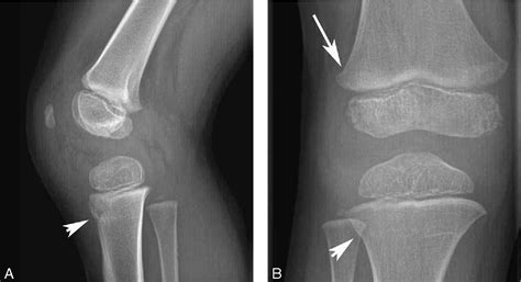 Figure 3 From Trampoline Fracture Of The Proximal Tibia In Children