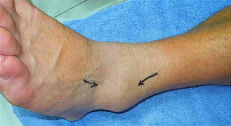 The Efficacy Of Manual Joint Mobilisation Manipulation In Treatment Of Lateral Ankle Sprains