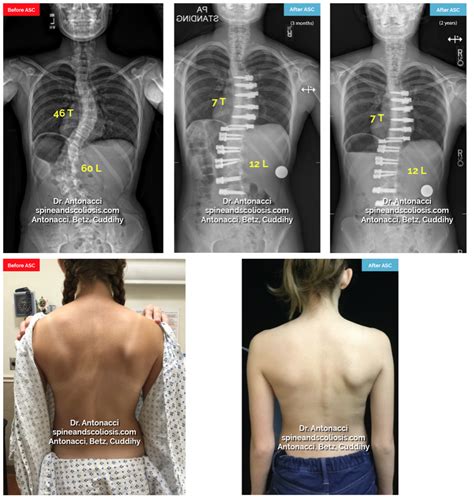 Di mana bahaya ini menyerang tulang punggung anda yang membuatnya membengkok dan tidak. Before and After ASC Scoliosis Surgery