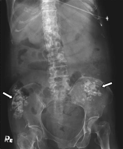 Abdominal And Pelvic X Ray Shows Multiple Calcified Soft Tissue