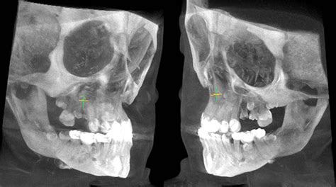 17 Craniofacial Reconstruction From A Cone Beam Ct Scan Of A Type Iii