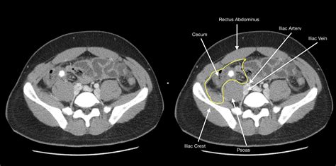 How To Find The Appendix On Imaging Stepwards
