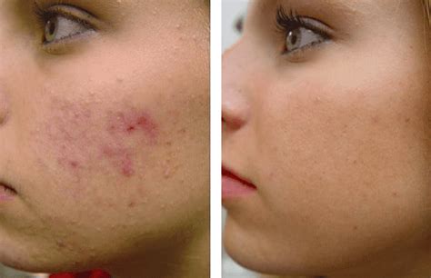 What To Know About Chemical Peel For Acne Scars Cosmetic Surgery Tips
