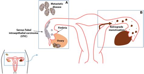 Frontiers Ovarian Cancer The Fallopian Tube As The Site Of Origin