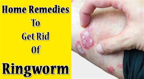 How To Get Rid Of Ringworms Naturally