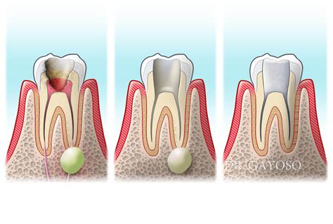 3 ¿cuántas raíces y canales radiculares puede tener un diente? Endodoncia - Clínica Dental Dr. Gayoso