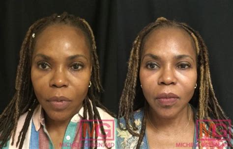 Cosmelan Before After Photos Dr Michele Green Md