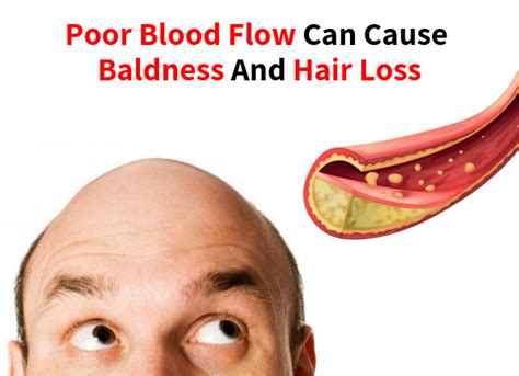 Some hair loss is caused by genetics, but there are other factors, such as foods that cause hair loss. Poor Blood Flow Can Cause Baldness and Hair Loss - Hair ...