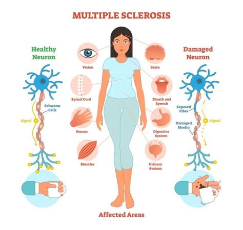 Multiple Sclerosis Causes Symptoms Diagnosis And Cure