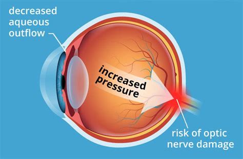 High Blood Pressure Eye Symptoms Wholesale Deals Save 69 Jlcatjgobmx
