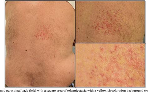 Figure 1 From Fluoroscopy Induced Chronic Radiation Dermatitis Should