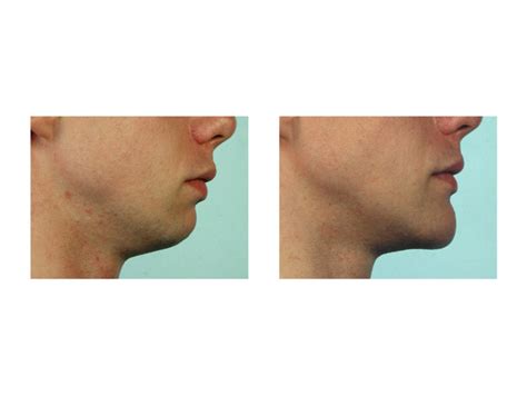 Blog Archivethe Vertical Lengthening Chin Implant
