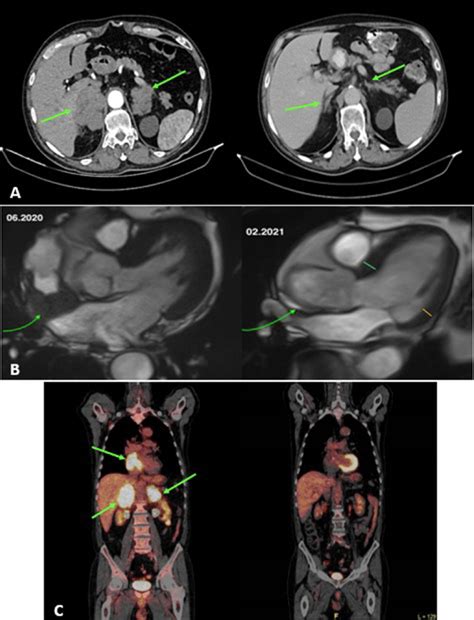 A Contrast Enhanced Adrenal Ct Comparisons Of Adrenal Masses Before