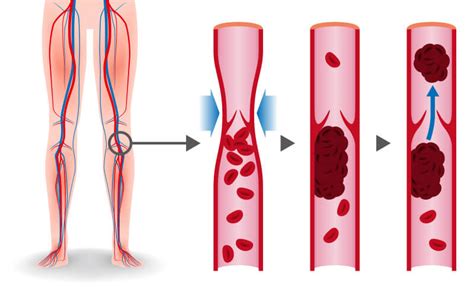 Thrombosis And Clotting Blood Clot Formation Ihtc