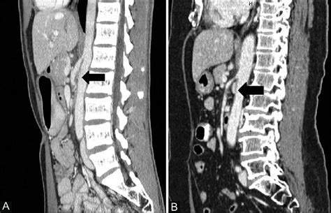superior mesenteric artery syndrome ct findings bmj c