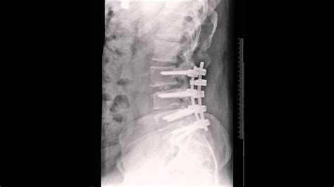 Back Fusion X Rays Post Op Youtube