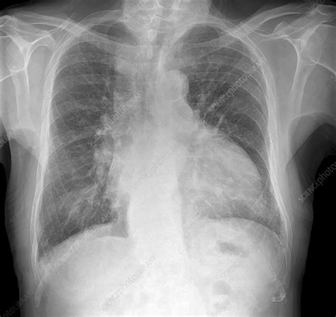 Cardiomyopathy Chest X Ray Stock Image C0533899 Science Photo