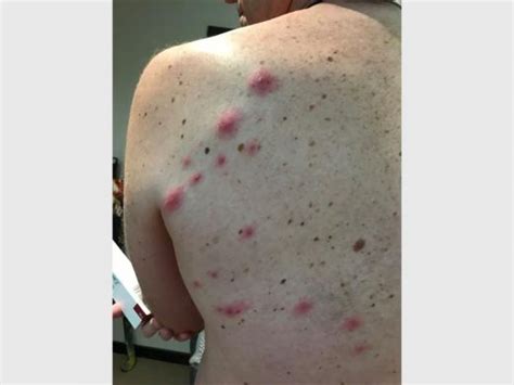 Man Warns Of Mango Fly Infestation In Humans The Citizen
