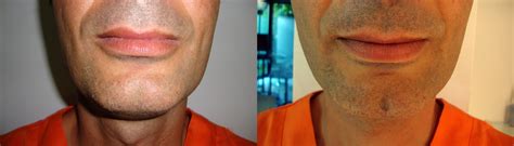 Chin Dimple Surgery