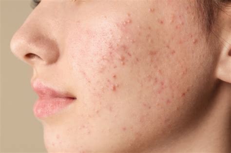 What Is The Best Acne Treatment For Sensitive Skin 4 Best Acne