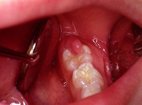 Operculectomy Dental Dental Health Dental Hygienist