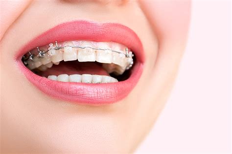 What You Need To Know About Self Ligating Braces Orthodontic Associates
