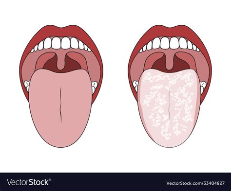How To Clean Tongue White How To Get The White Off Your Tongue