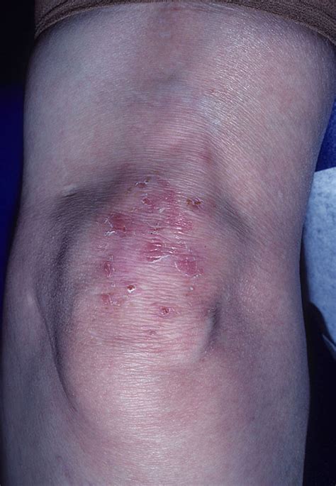 Dermatitis Herpetiformis Duhrings Disease التهاب الجلد العقبولي