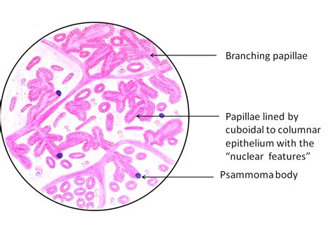 What was the name of daddy warbucks's giant bodyguard who wore a turban in the little orphan annie comic strip? Papillary Carcinoma - Thyroid - Pathology Made Simple