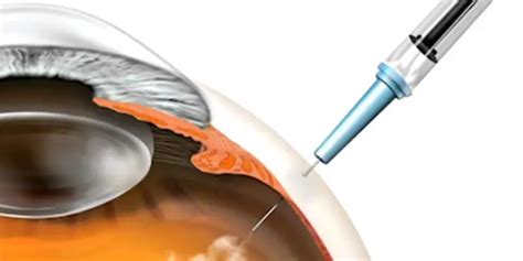 Many Wet Amd Patients Lost To Follow Up After Anti Vegf Injections