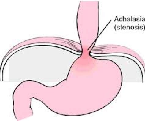 Achalasia Cardia Signs And Symptoms Diagnosis And Management