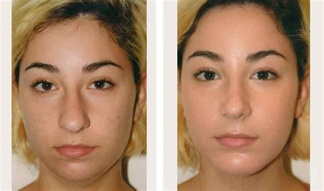 Rhinoplasty Nyc Cost Recovery Reviews Before After Pics
