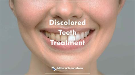 Teeth Discoloration The Causes And What You Can Do About It Medical
