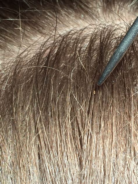 My Lice -Head Lice Removal - Lice Services - Land O Lakes ...
