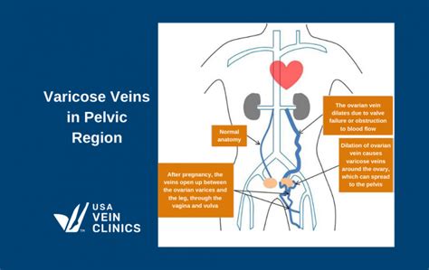 Varicose Veins During Pregnancy The Complete Guide