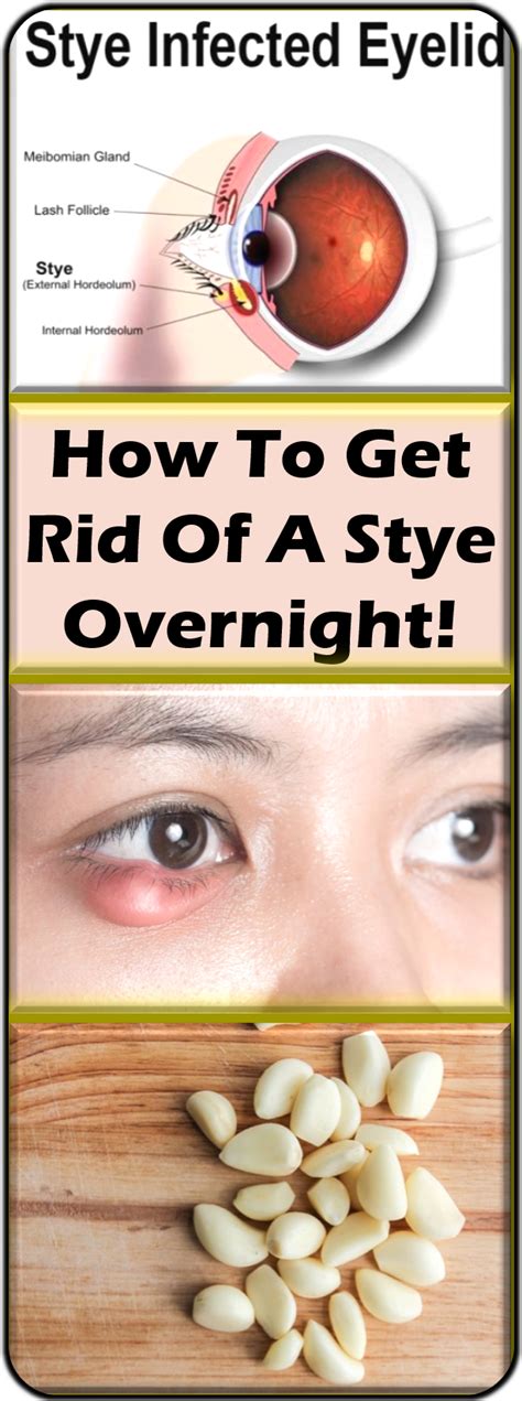 A Stye Is Very Painful Not To Mention That In Some Cases Your Eye