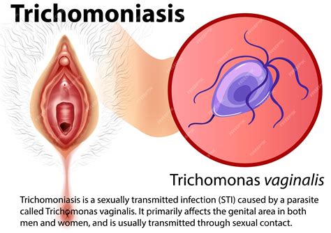 Trichomoniasis Women