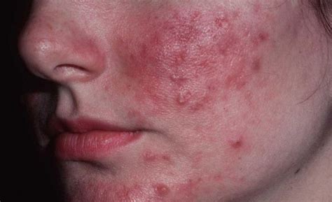 Rosacea Natural Treatments That Really Work Red Spots On Face Acne