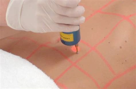 Price is usually a good indicator of the technology they use as the true medical grade lasers will be a much bigger financial outlay. Laser Hair Removal Experts | Servicing Brisbane and the ...