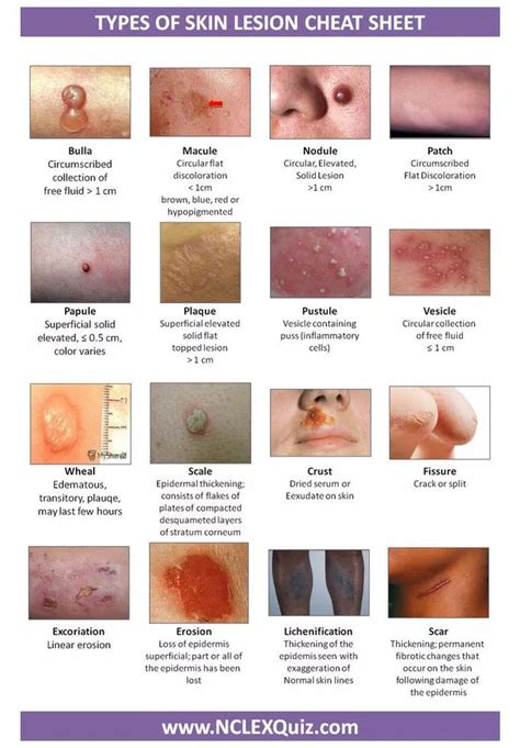 Medizzy Types Of Skin Lesion Cheat Sheet Nursing School Survival Nursing School Tips