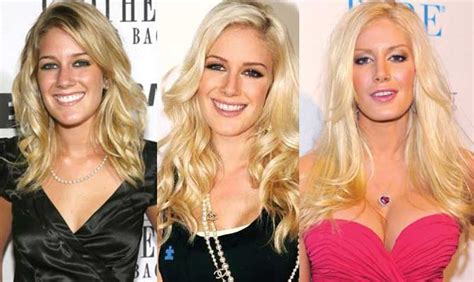 Heidi Montag Plastic Surgery Before And After Pictures 2020