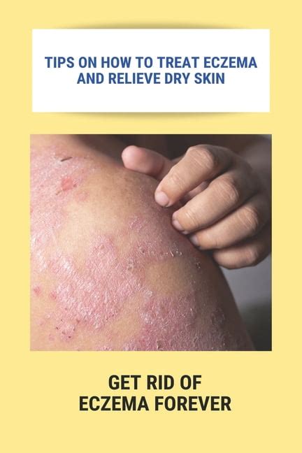 Tips On How To Treat Eczema And Relieve Dry Skin Get Rid Of Eczema